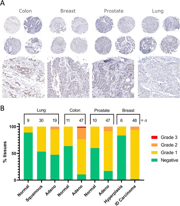 Human-Tumor-Staining-with-Grading