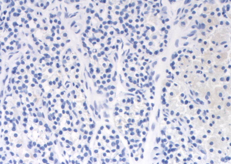 PFM - Parathyroid TCR